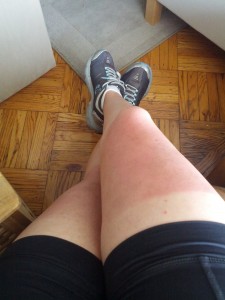 Sunburned legs